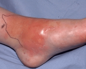 Cellulitis