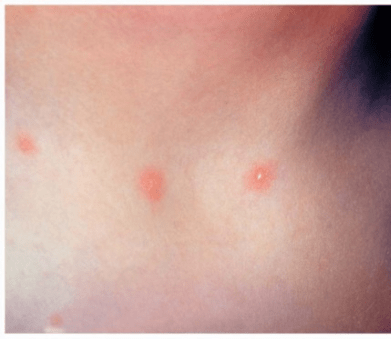 Chicken Pox (Varicella-Zoster Virus)