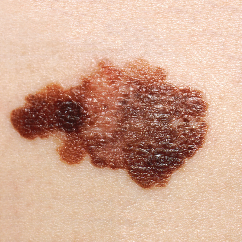 Melanoma