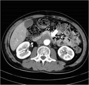 Abdominal Aortic Aneurysm&nbsp;(AAA)