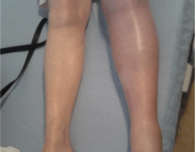 Deep Vein Thrombosis